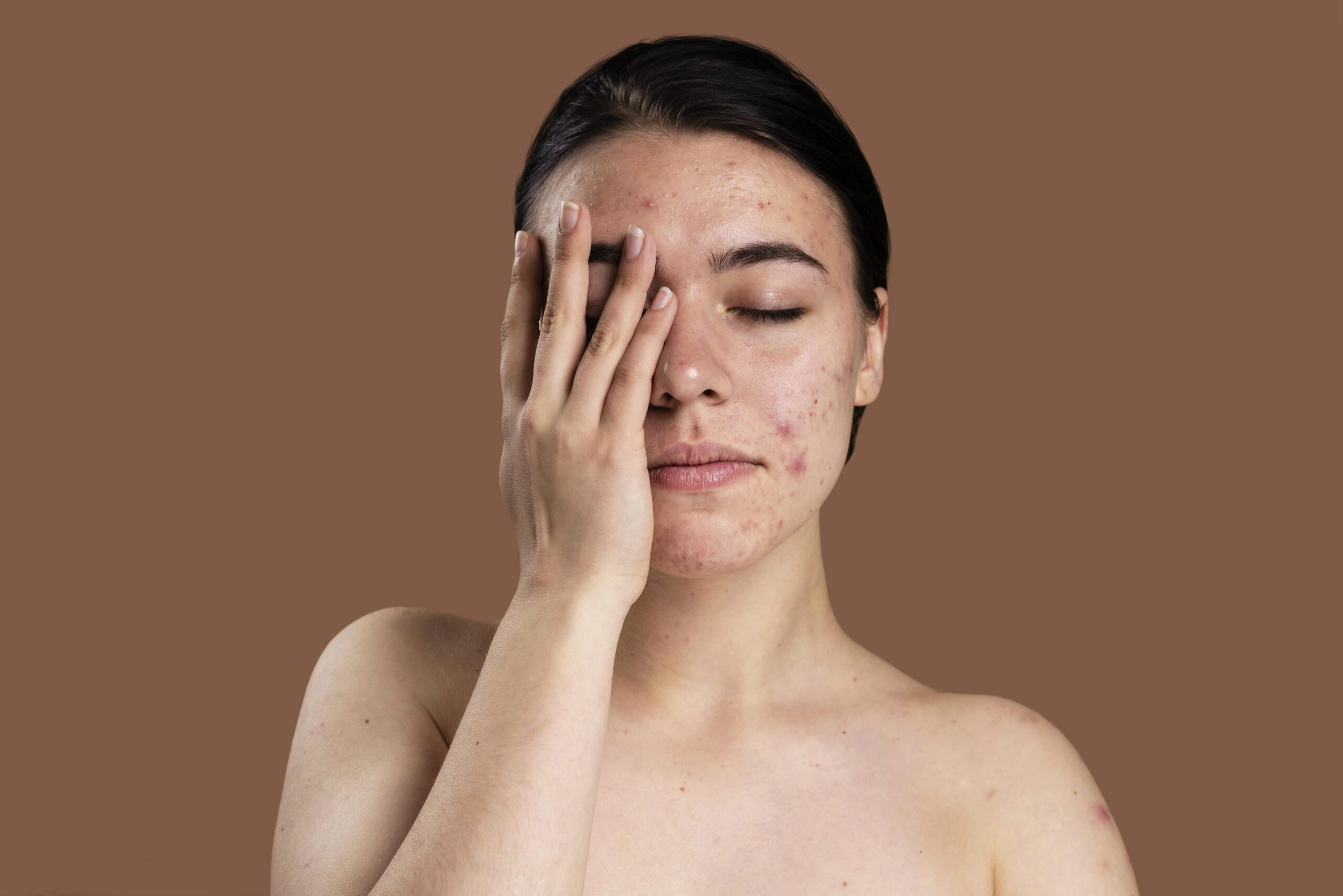 5 Surprising Causes of Acne and How to Prevent Them